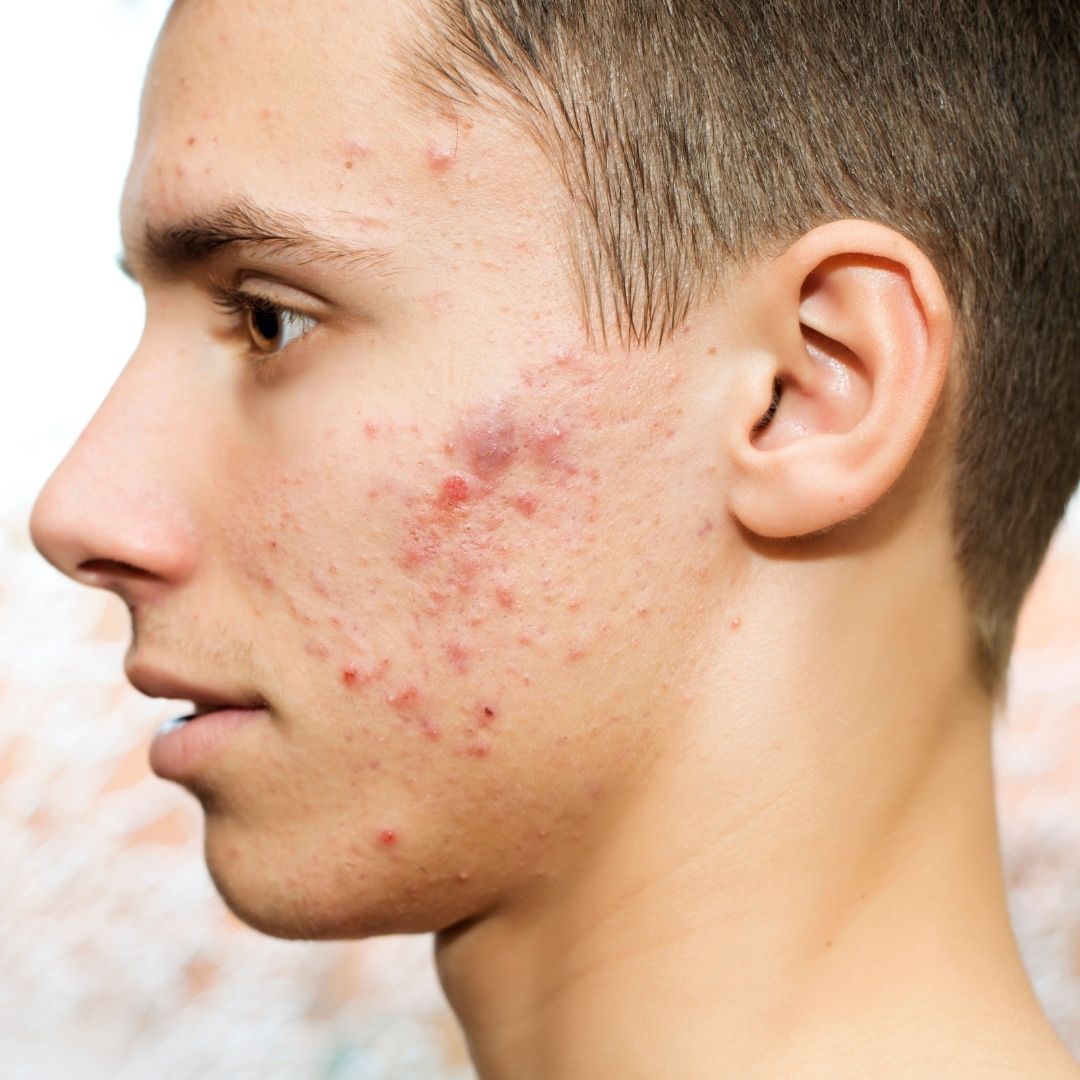 Close-up of a young man’s left profile showing cystic acne with red, pitted scars on his cheek