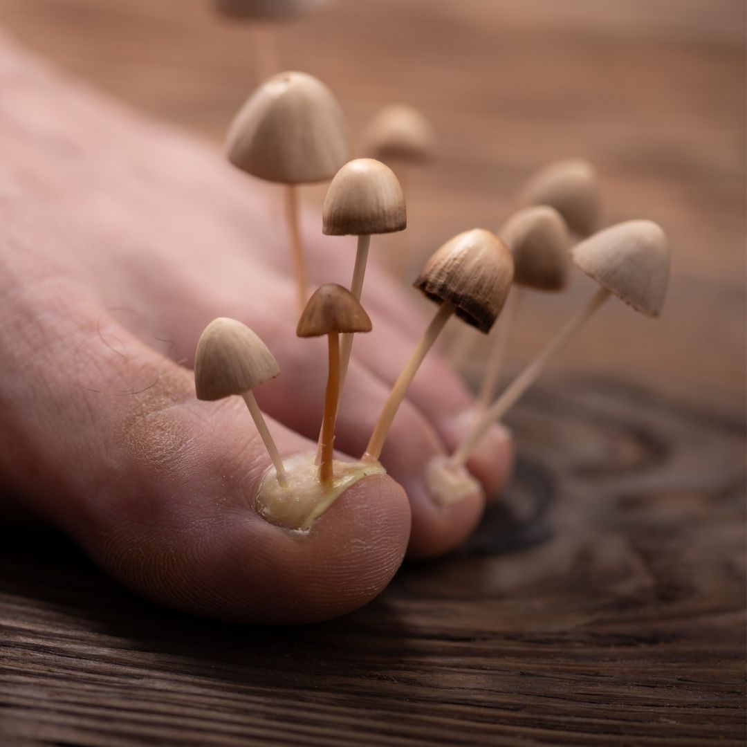 Close-up of toes with small mushrooms growing from under the toenails on a wooden surface, illustrating toenail fungus