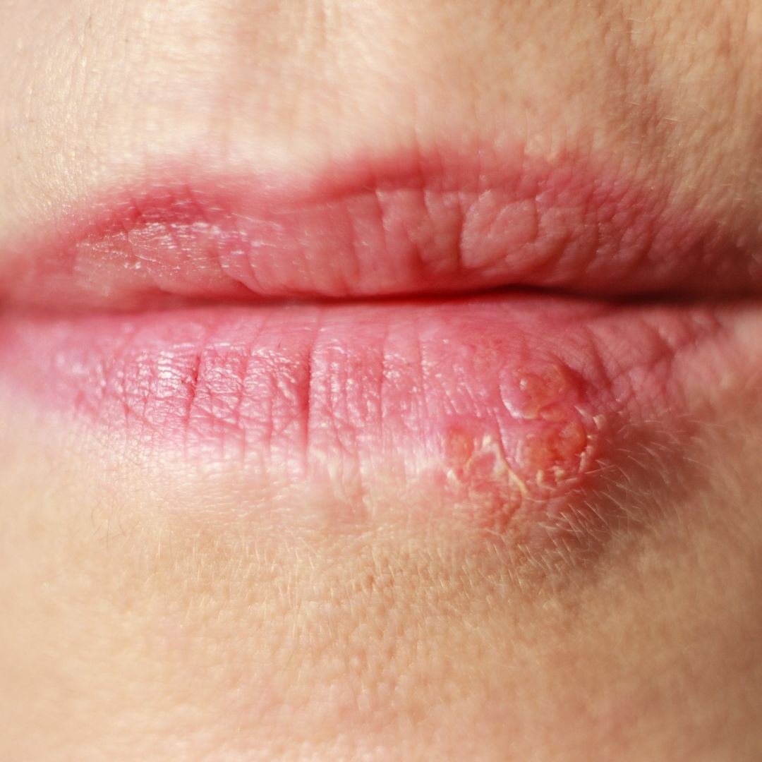 Close-up of a lower lip showing a cluster of fluid-filled blisters consistent with a cold sore
