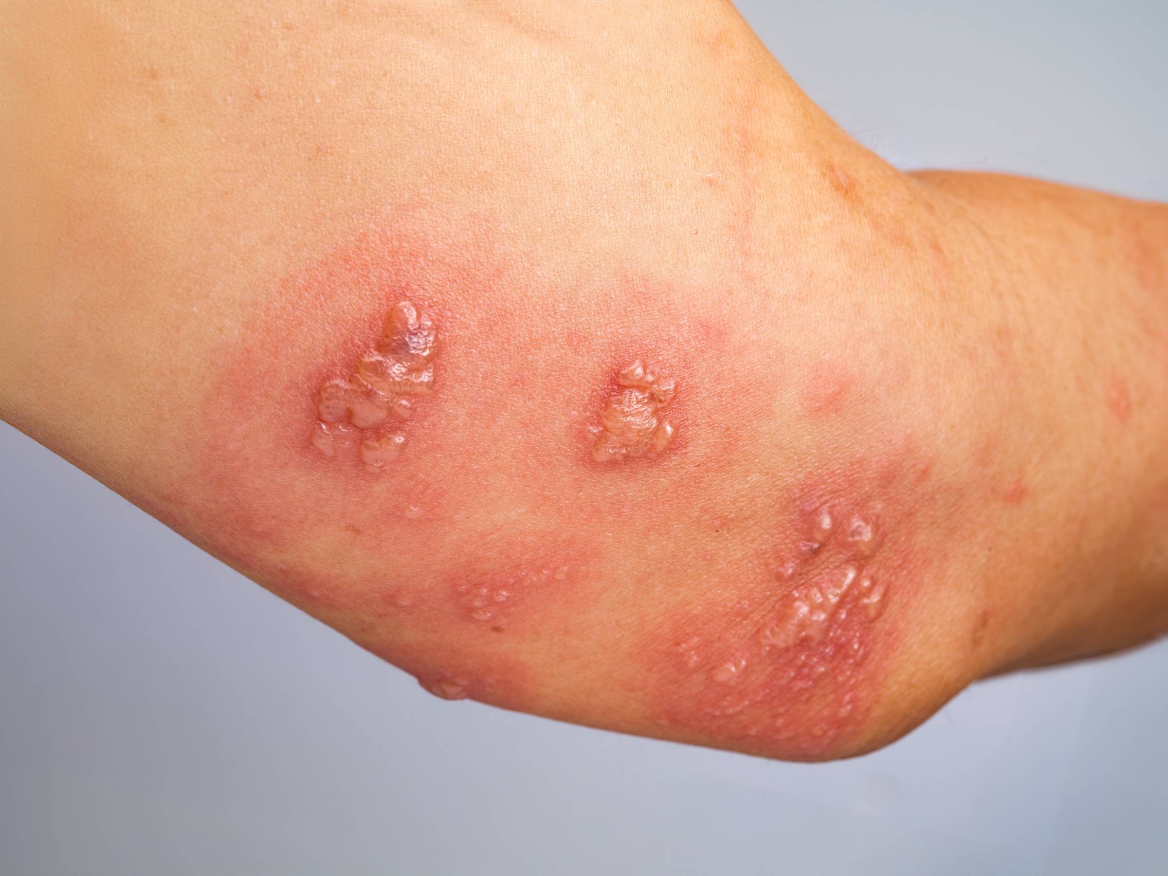 Close-up of an elbow with clustered fluid-filled blisters and surrounding redness, typical of a shingles rash