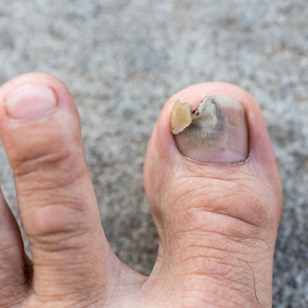 Close-up of a big toe with a thick yellow partially detached toenail showing signs of fungal infection on a gray background