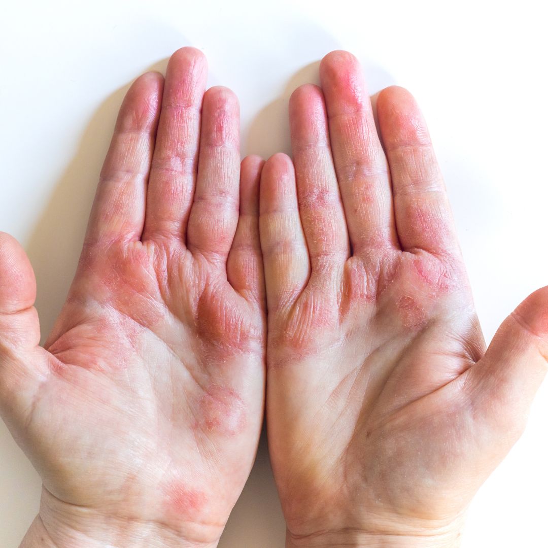 Two palms held up showing red, dry, scaly eczema patches and cracked skin against a white background