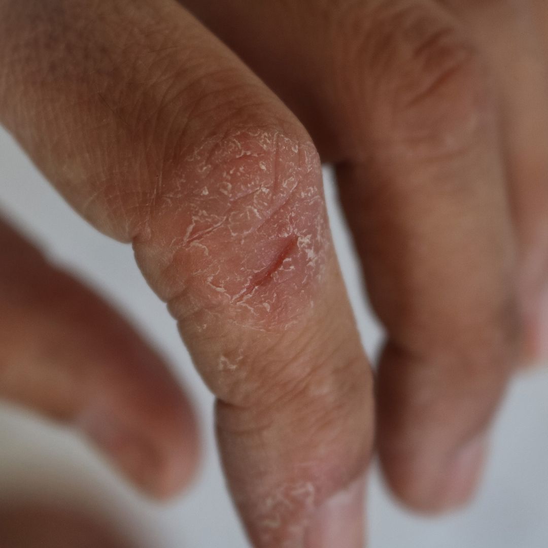 Close-up of a finger showing cracked, scaly psoriasis on the knuckle