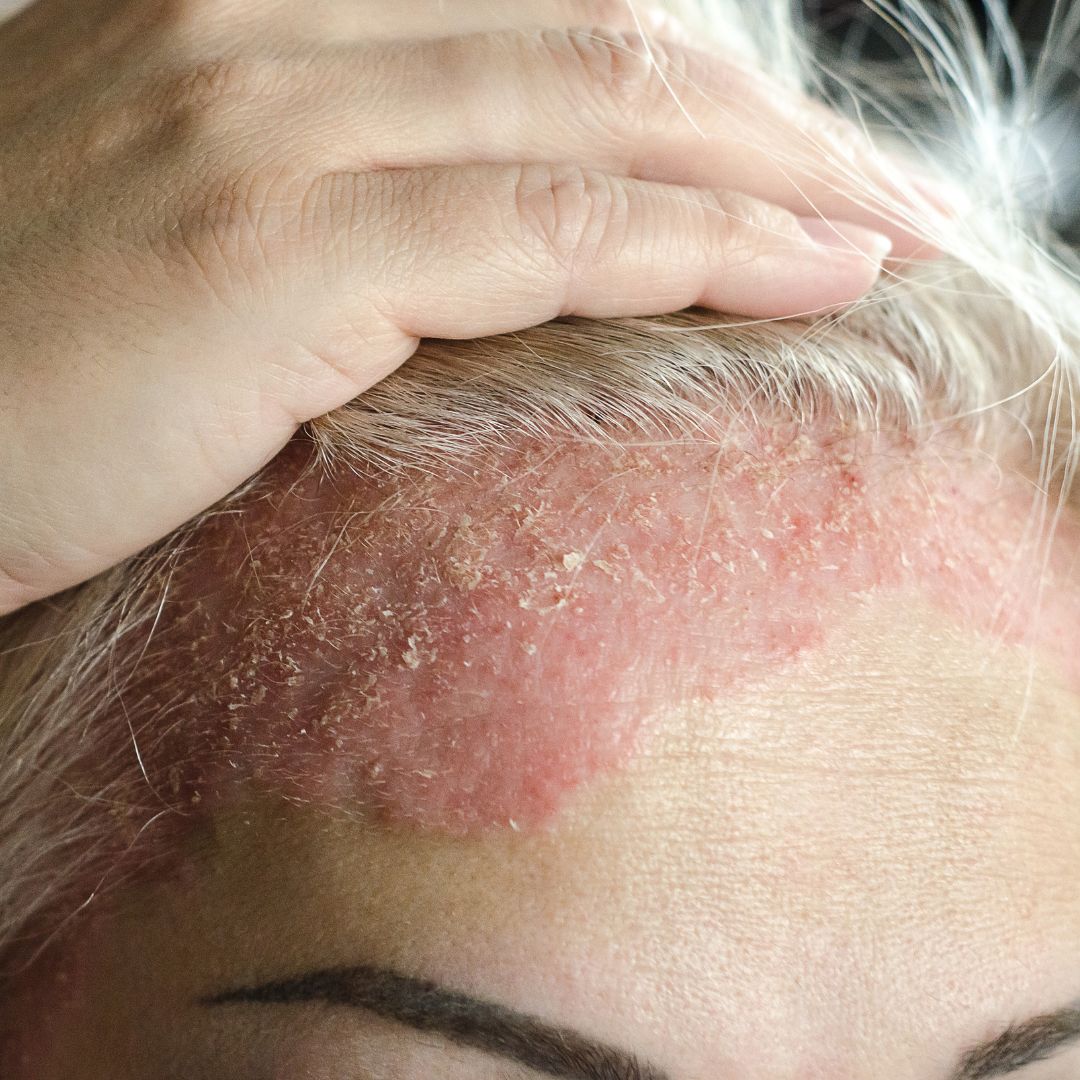 Close-up of inflamed, scaly patch along the hairline with a hand holding hair back to reveal scalp psoriasis