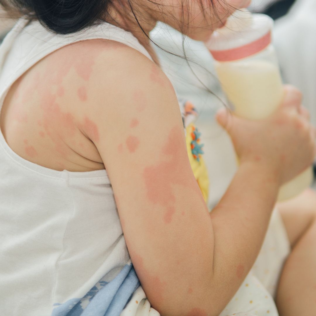 Young child with red, patchy eczema on upper arm holding a bottle