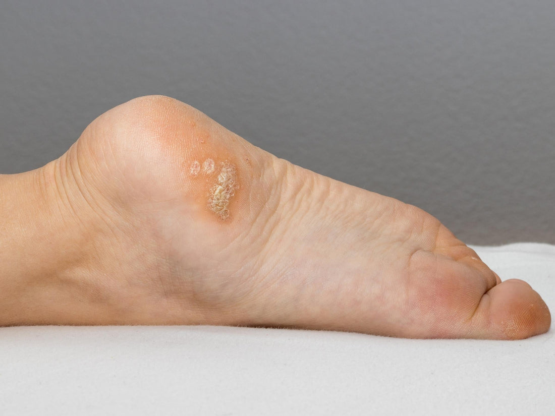 Close-up of the ball of a foot showing a crusty plantar wart against a neutral gray background