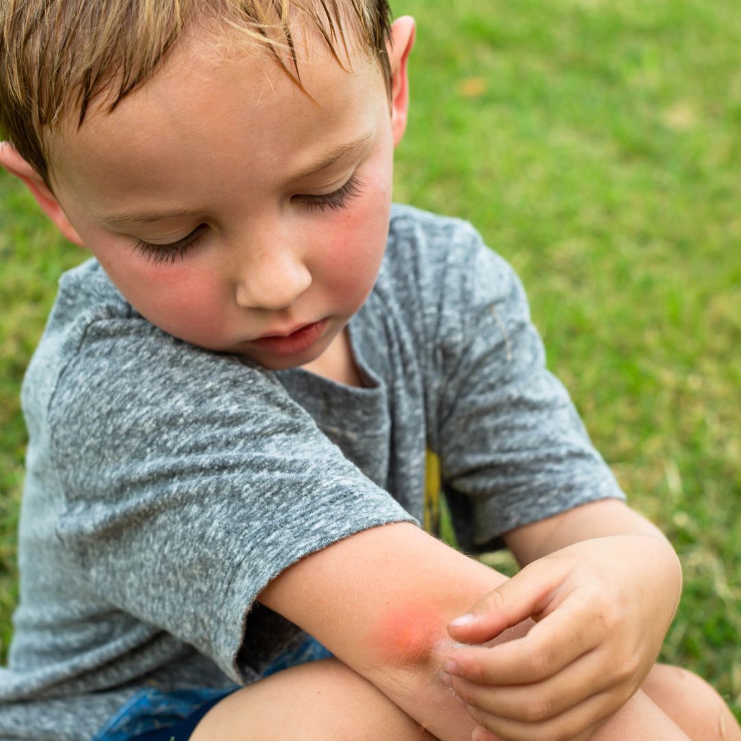 Young boy inspecting a red, swollen bug bite on his forearm while sitting on grass