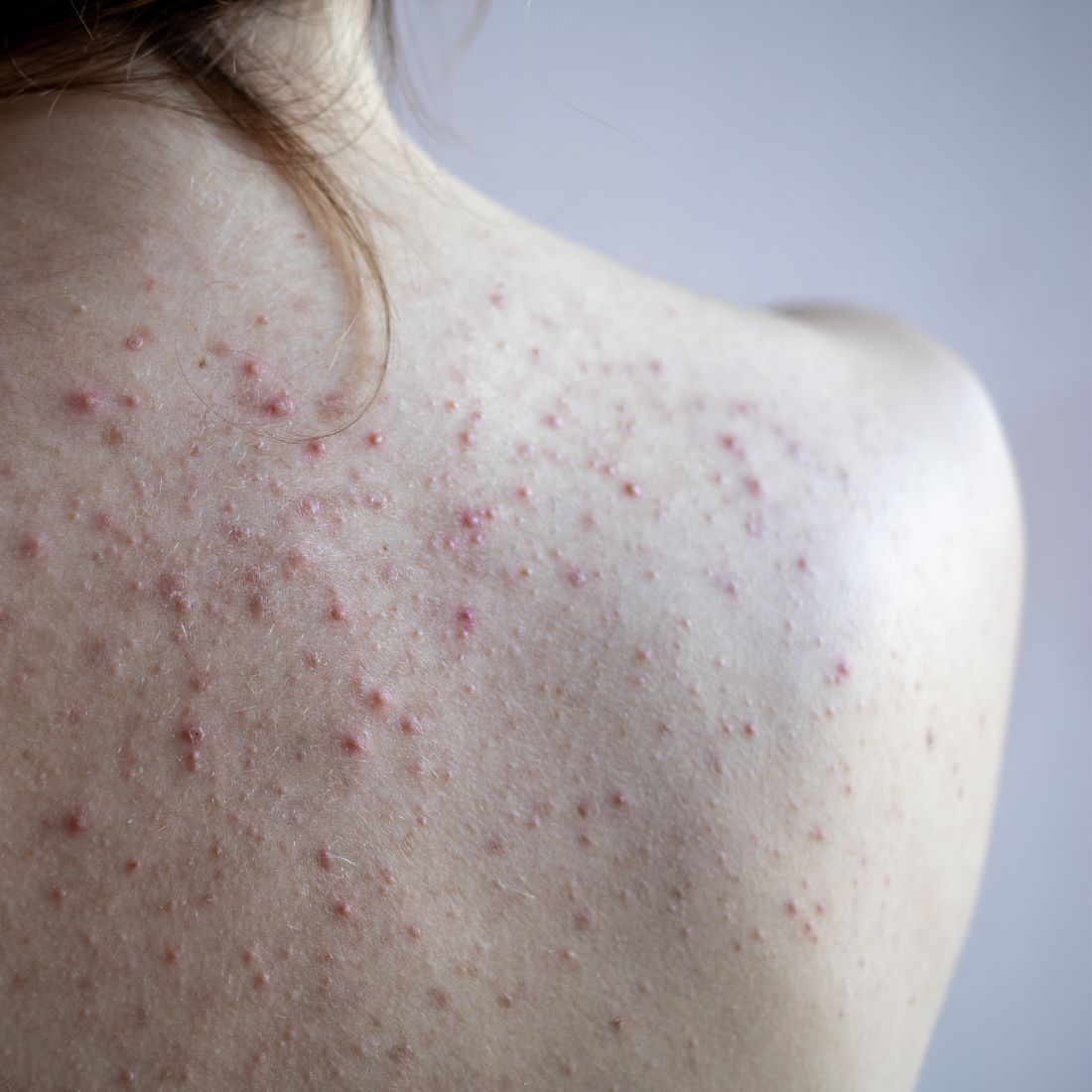 Close-up of a bare upper back showing scattered red acne bumps and inflamed lesions