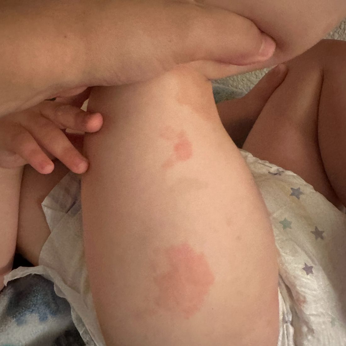 Young child’s leg showing red, patchy eczema on inner thigh and knee with diaper visible