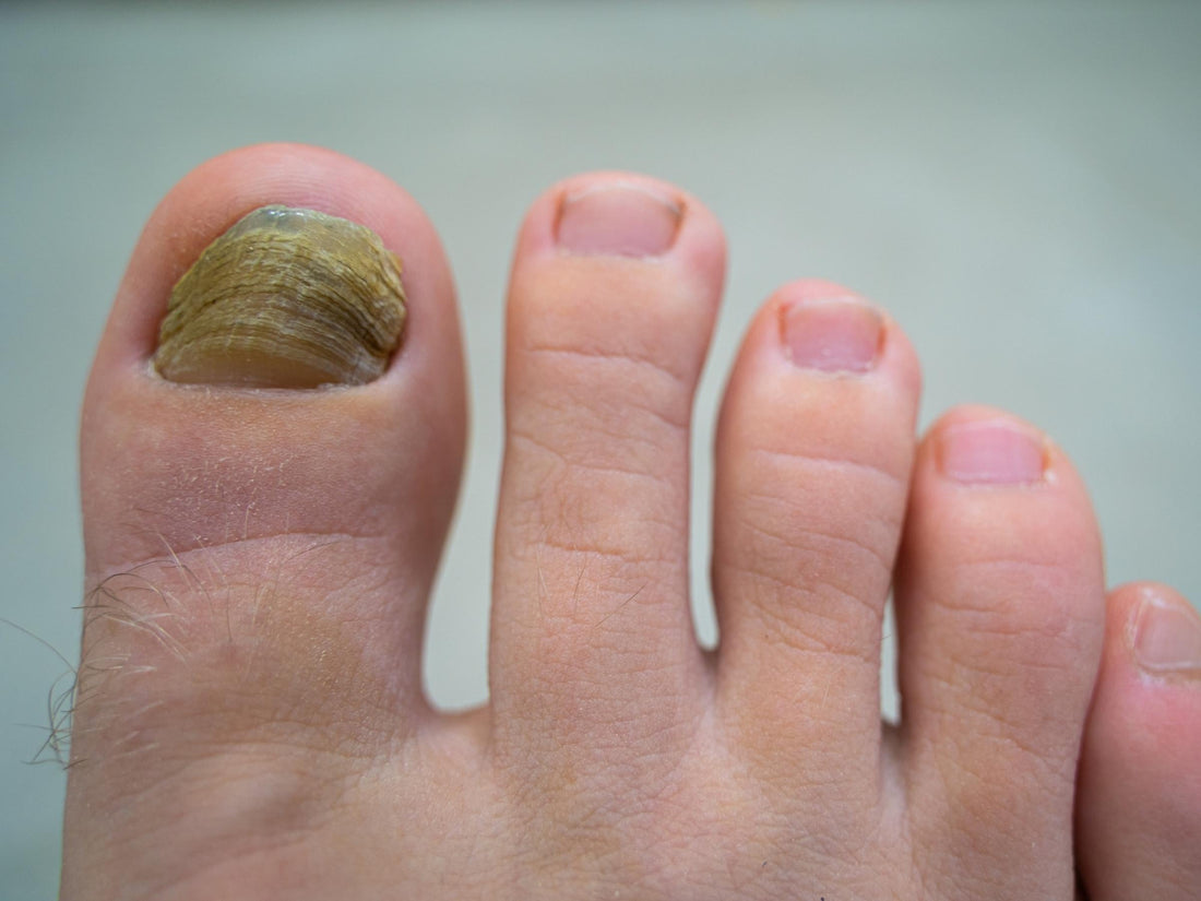 Big toe showing a thick greenish-yellow fungal toenail next to normal toes on a pale background