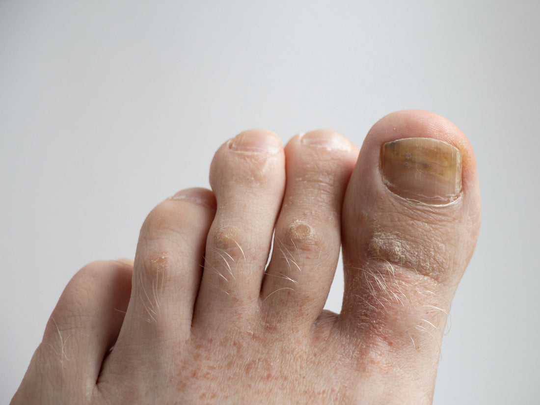 Big toe and adjacent toes with a thickened yellow-brown toenail suggesting fungal infection on gray background