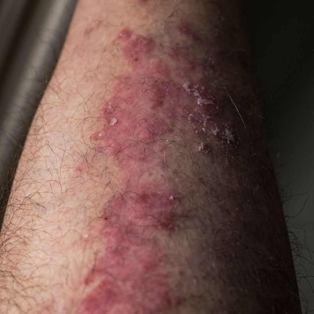 Close-up of a forearm showing inflamed, scaly red eczema patches with flaking skin