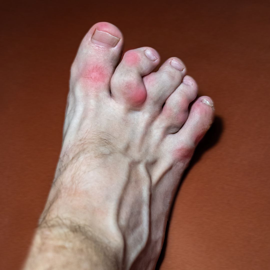 Left foot showing swollen, red big toe and inflamed toe joints consistent with gout against a plain brown background
