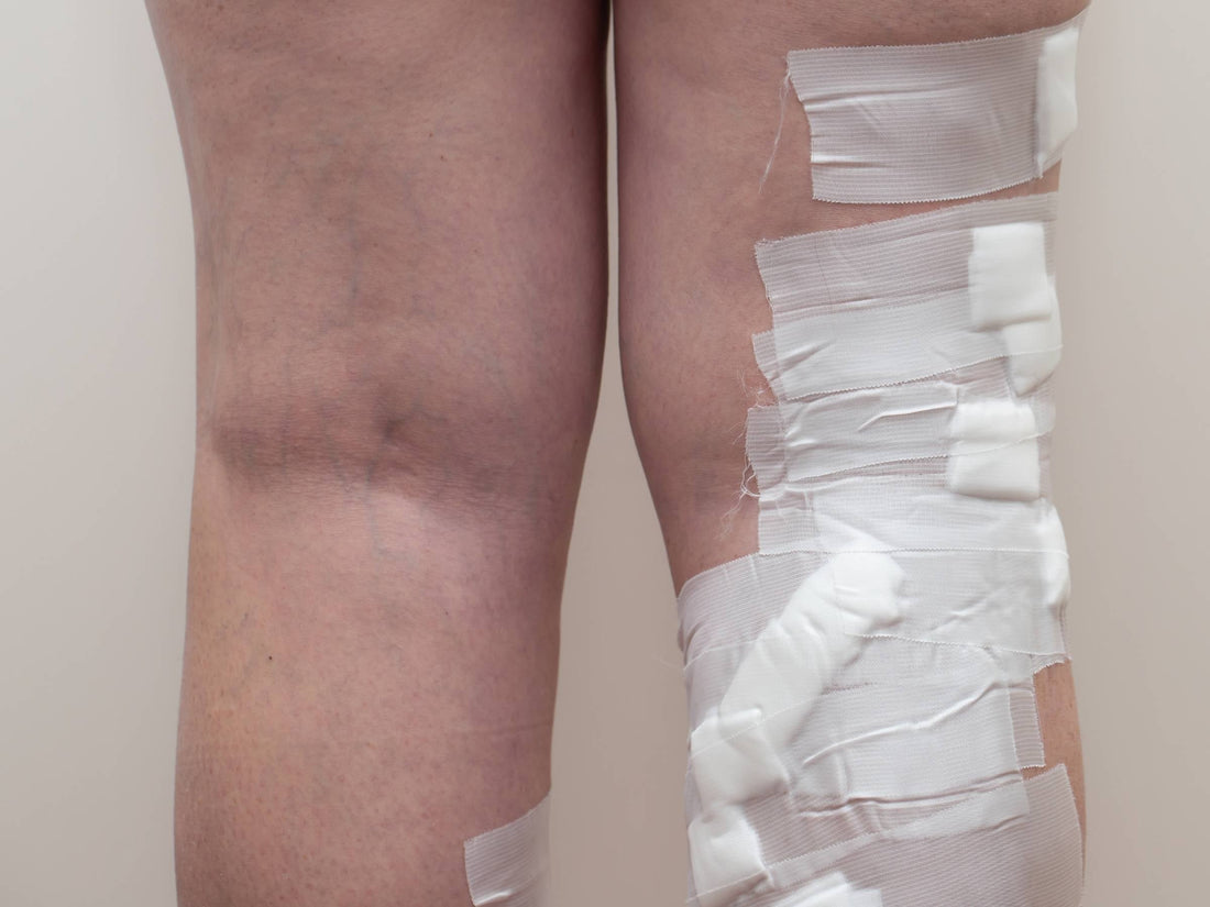 Post-sclerotherapy thighs with compression bandage on right leg and visible varicose veins on left