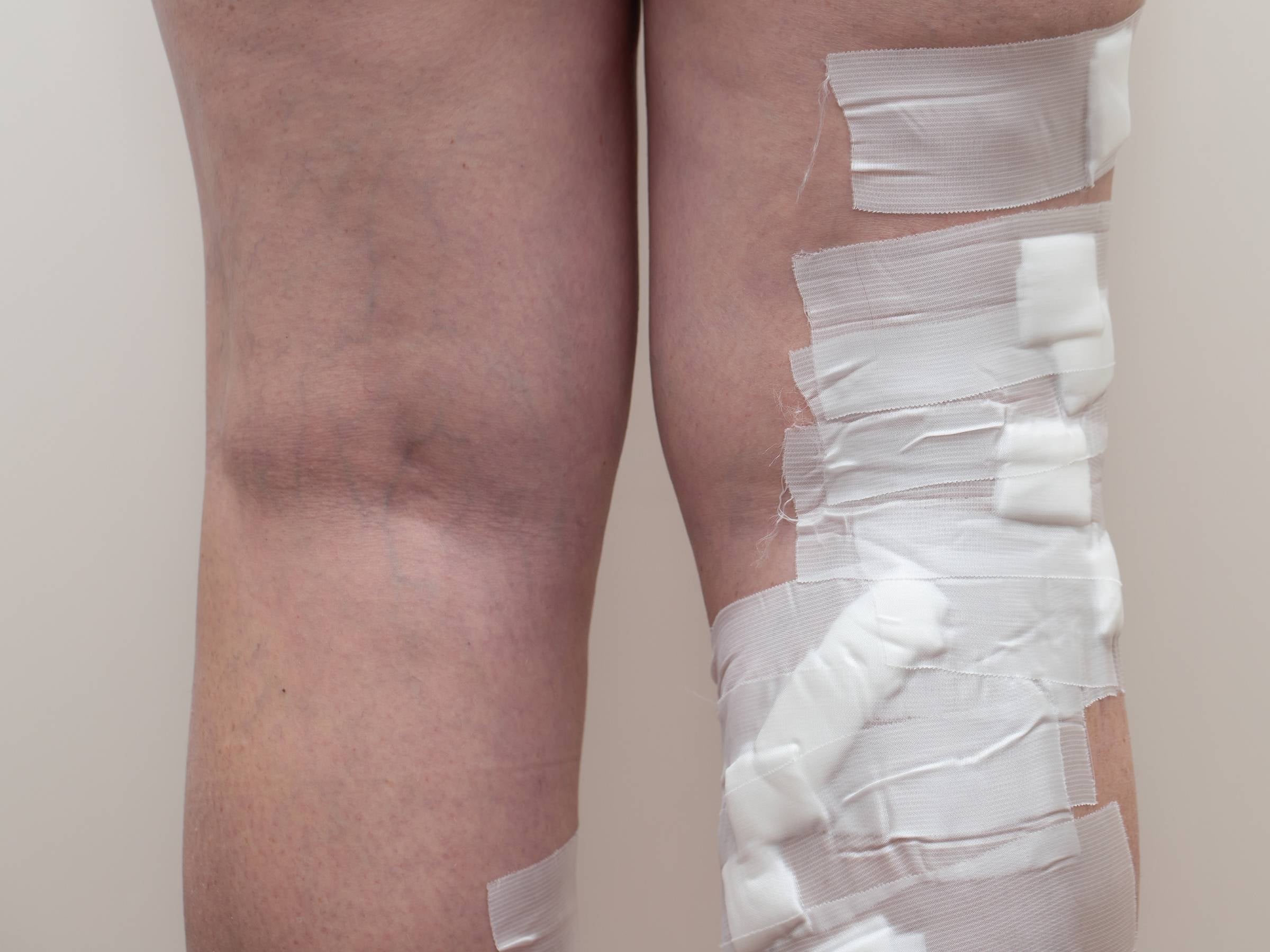Post-sclerotherapy thighs with compression bandage on right leg and visible varicose veins on left