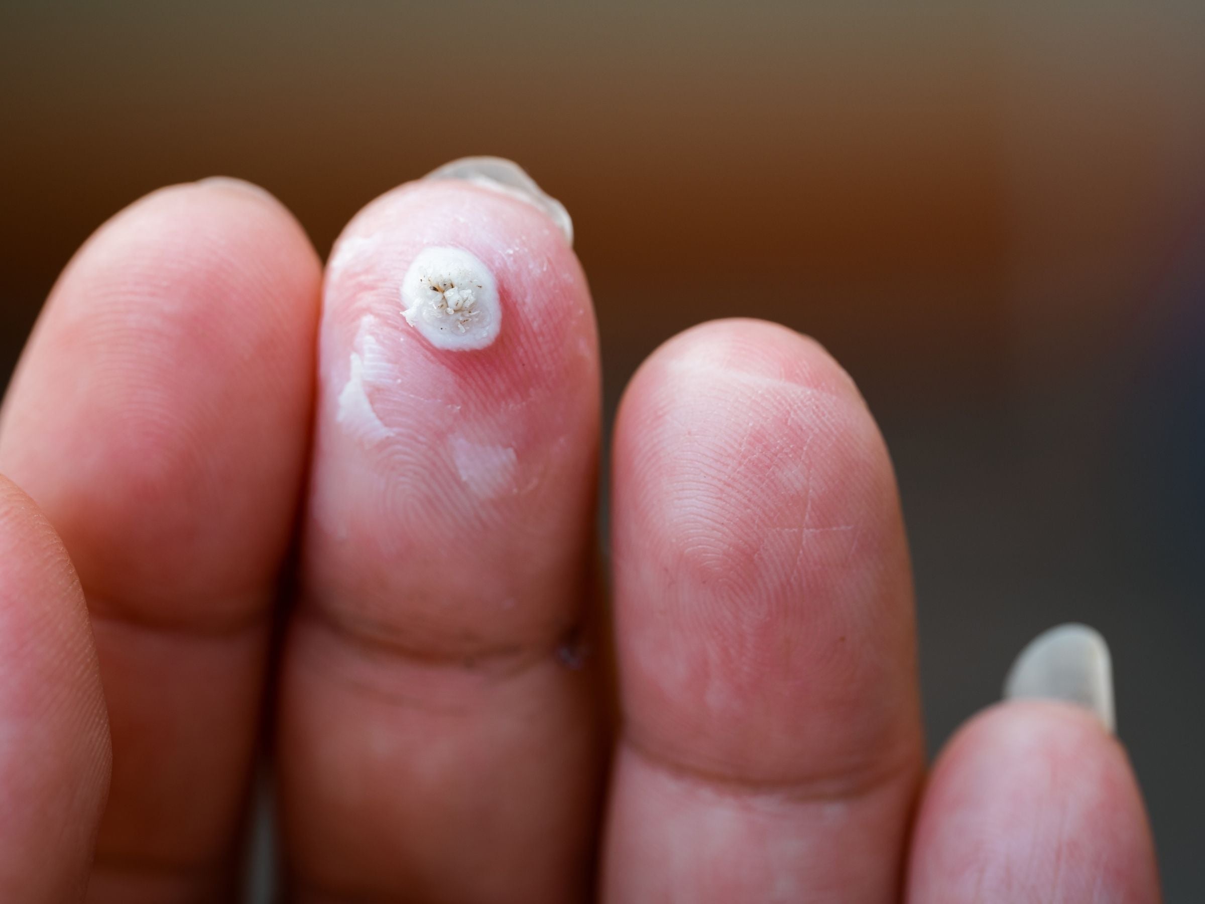 Close-up of a fingertip showing a common wart with a white, cauliflower-like surface against a blurred brown background