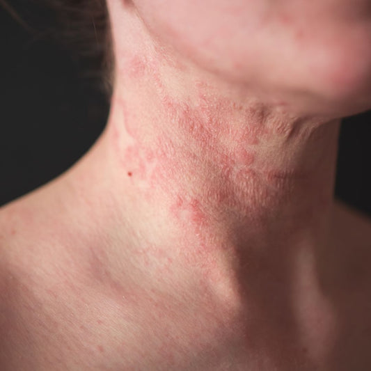 Woman with eczema on her neck