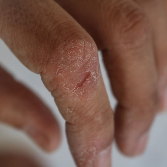 Fingers with psoriasis