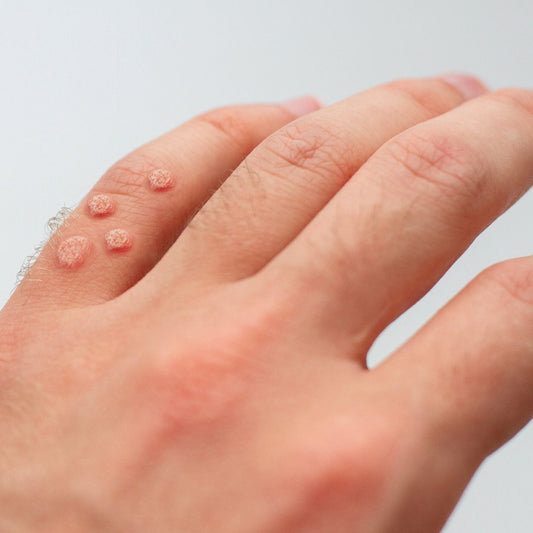 Wart on finger of man