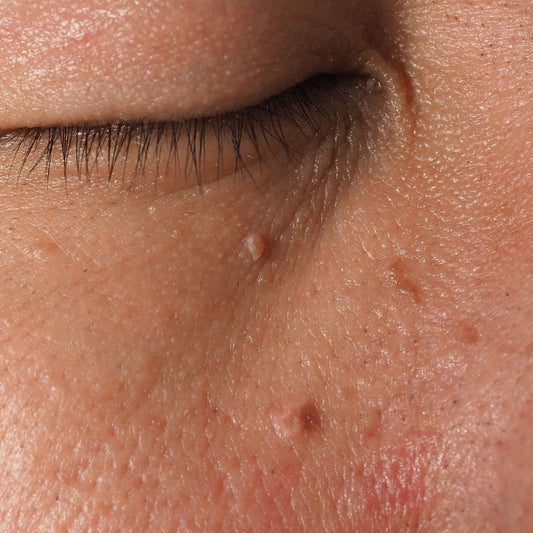 6 Skin Tag Myths You Need to Stop Believing