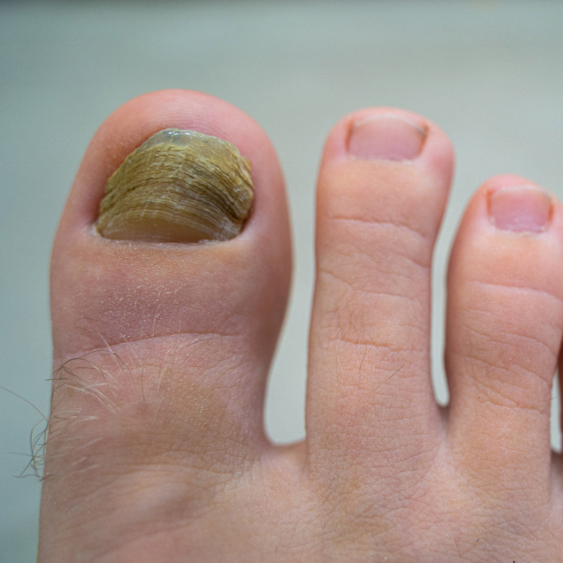 Close-up of toenail with fungal infection showing thickened and green discolored nail.