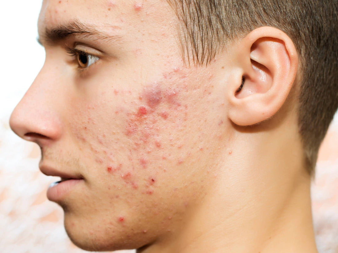 Close-up of a young man’s left profile showing cystic acne with red, pitted scars on his cheek