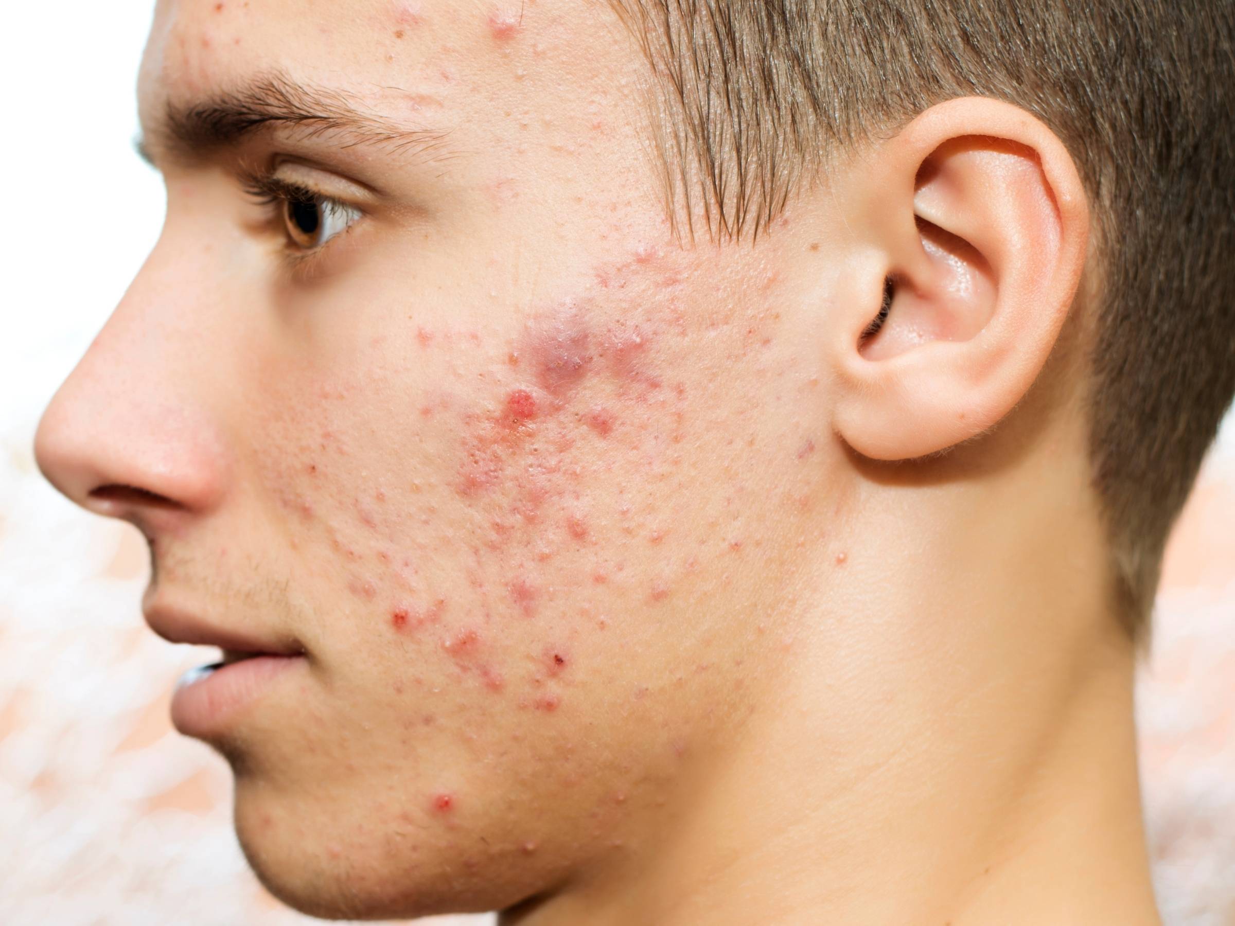 Close-up of a young man’s left profile showing cystic acne with red, pitted scars on his cheek