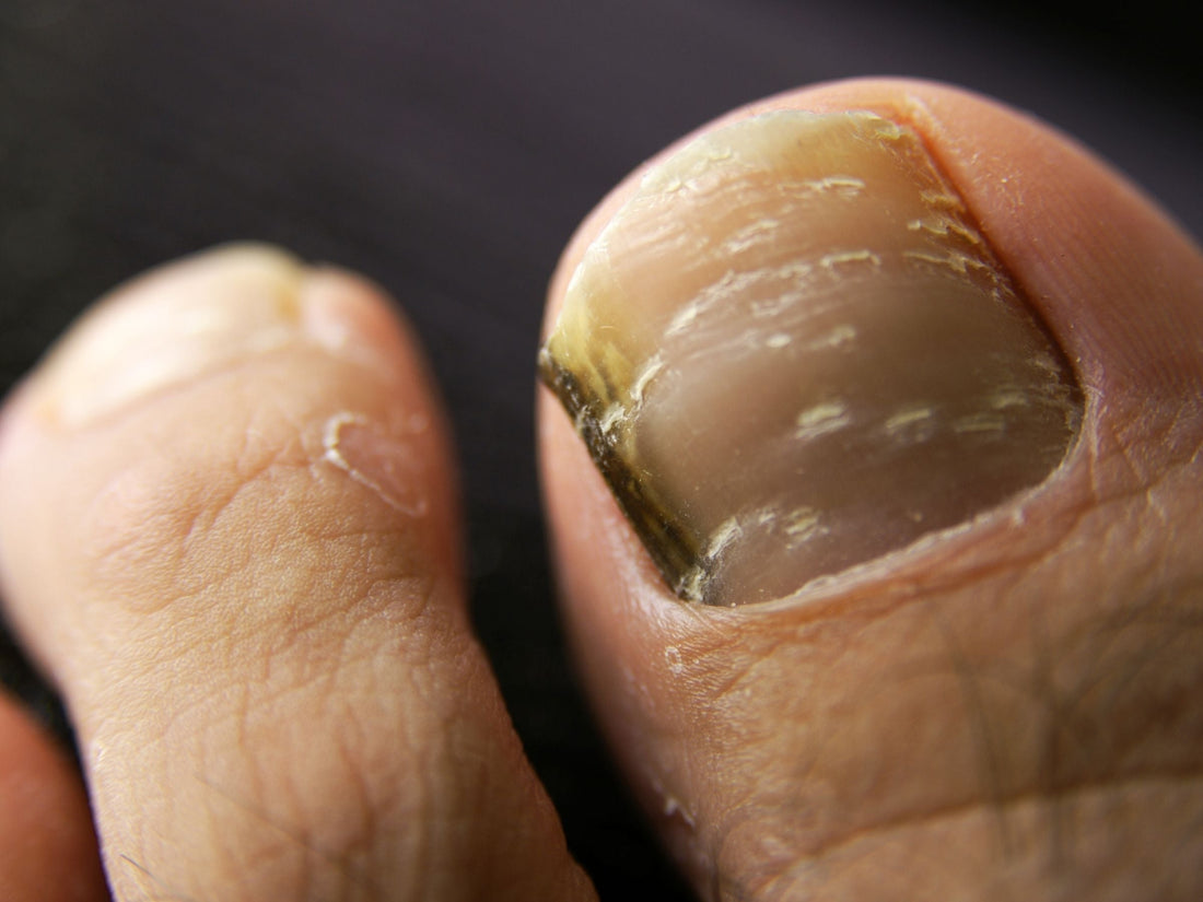 Close-up of a big toe with a thick, darkened and yellowed toenail showing signs of fungal infection against a dark background