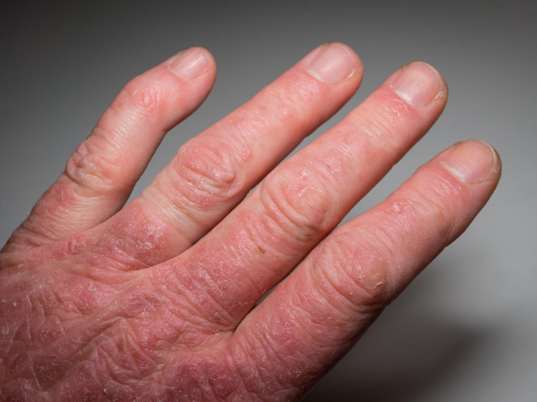 Close-up of a hand with red, scaly, dry, cracked skin on the fingers illustrating psoriatic arthritis