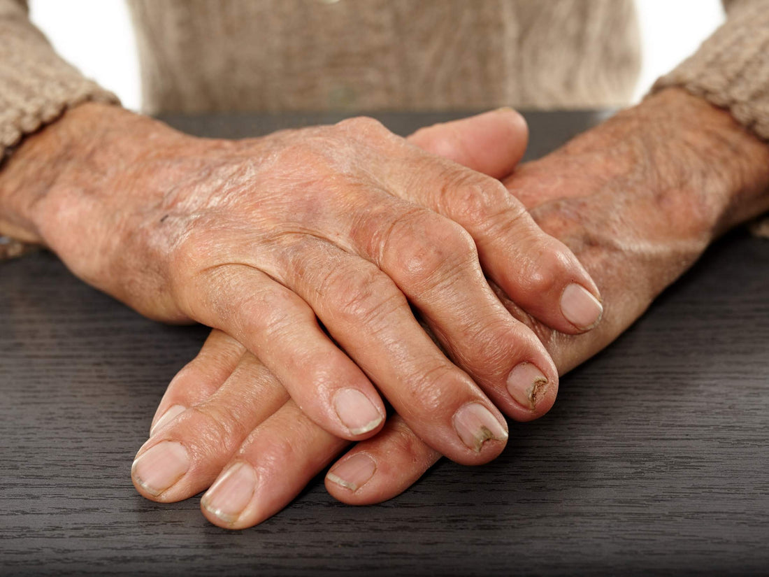 The Link Between Psoriasis and Arthritis: Exploring Psoriatic Arthritis