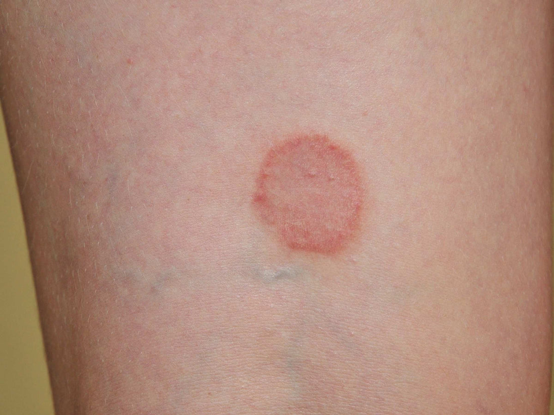 Ringworm on leg