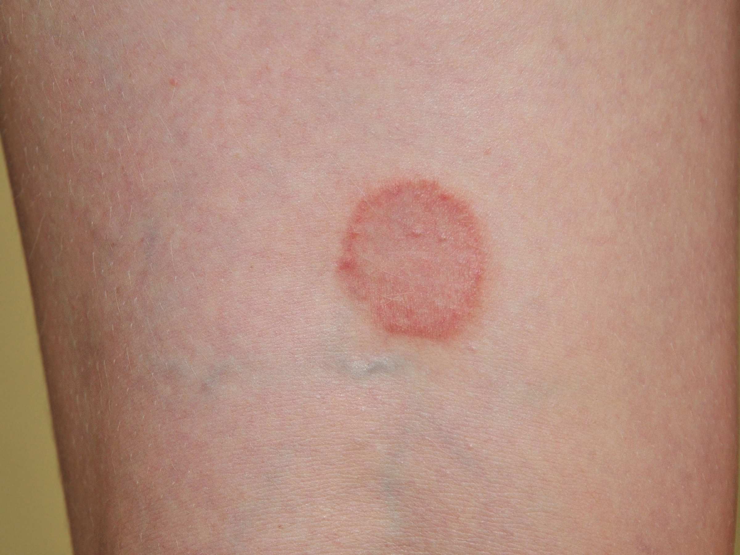 Ringworm on leg
