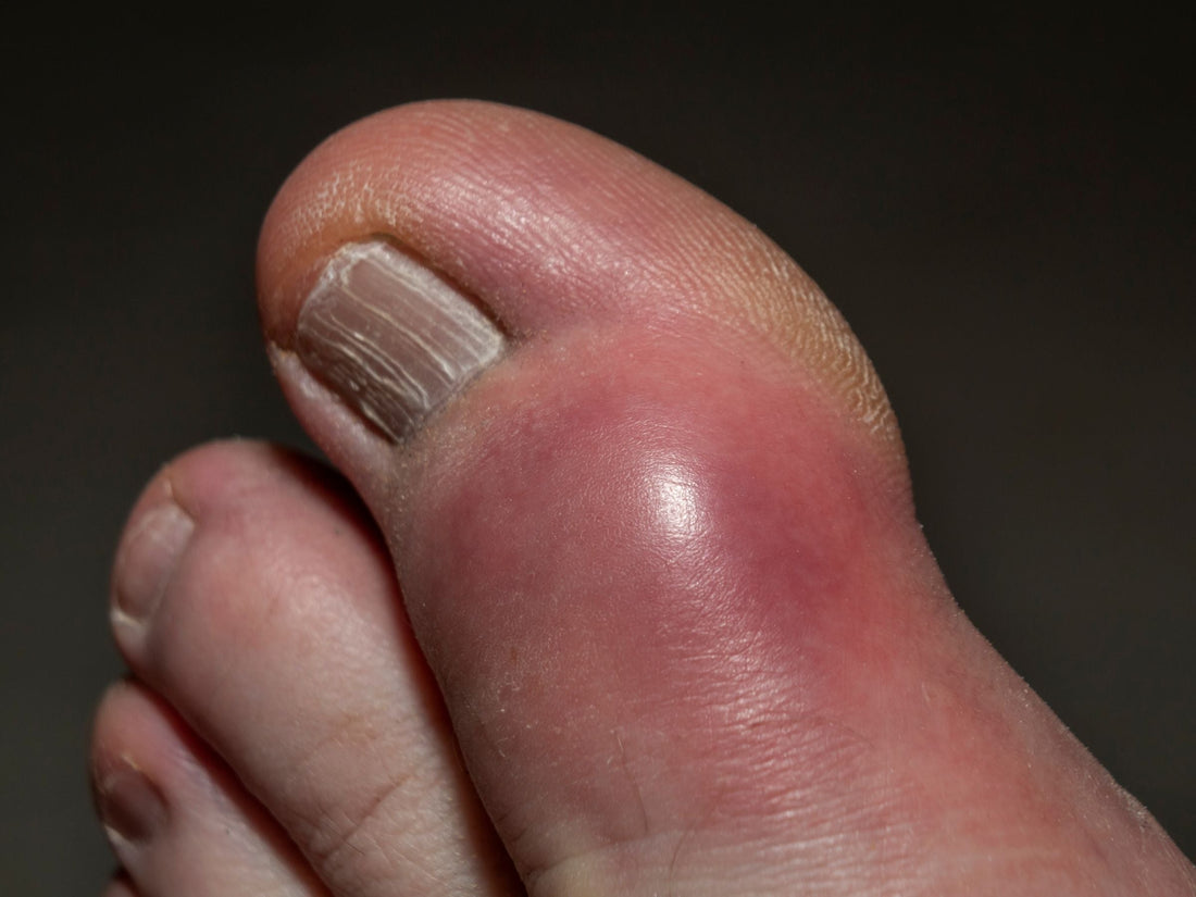 Defining Gout and Exploring Treatment Options
