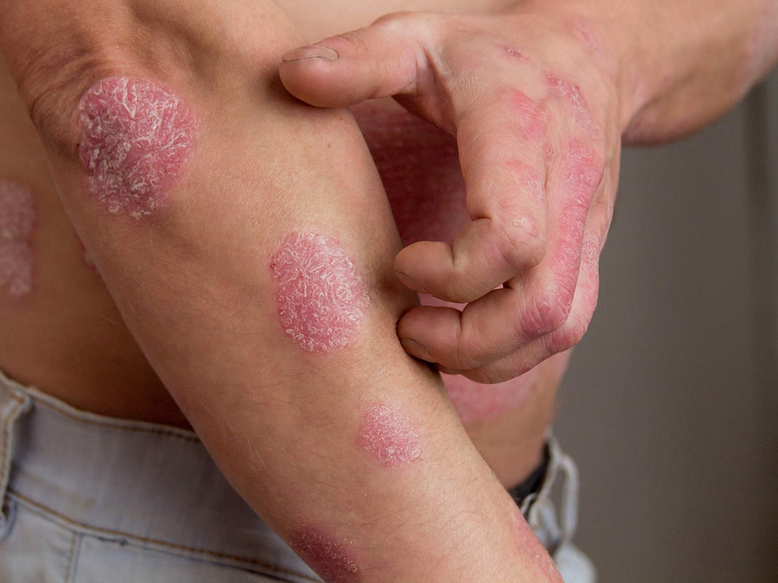 Close-up of a forearm and hand showing round, scaly red plaques of plaque psoriasis with the person touching an affected area