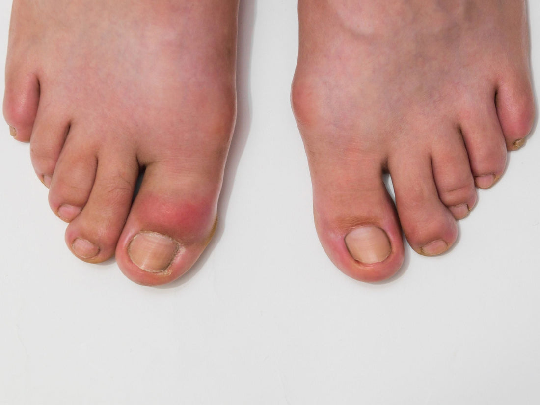Gout feet