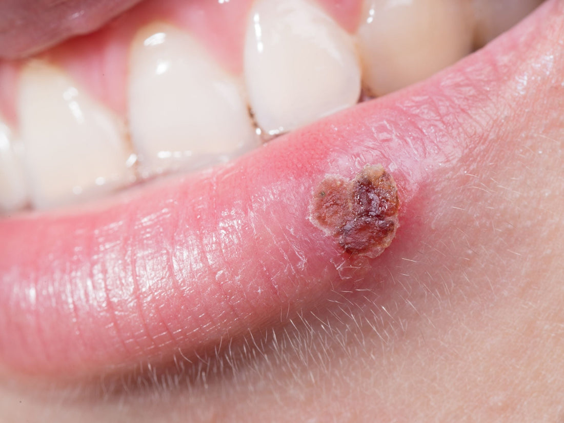 Everything You Need to Know About Cold Sores