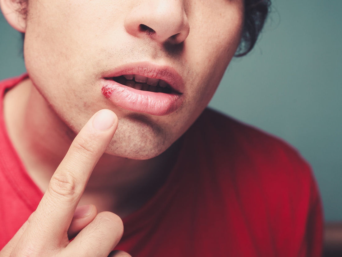 Man touching cold sore on lip
