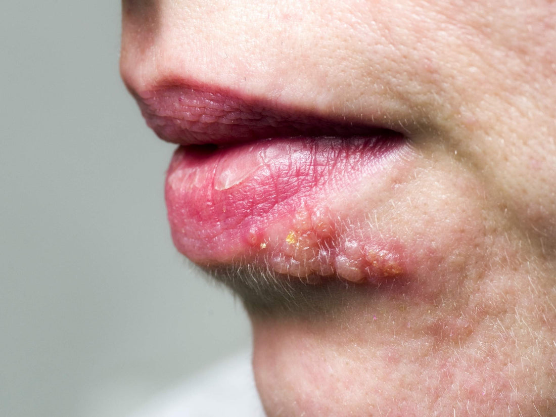 Woman with herpes on lip