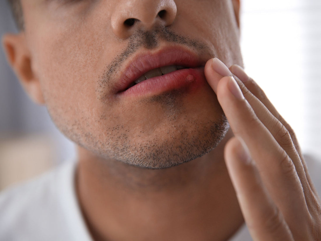 Man touching lip with cold sore or acne