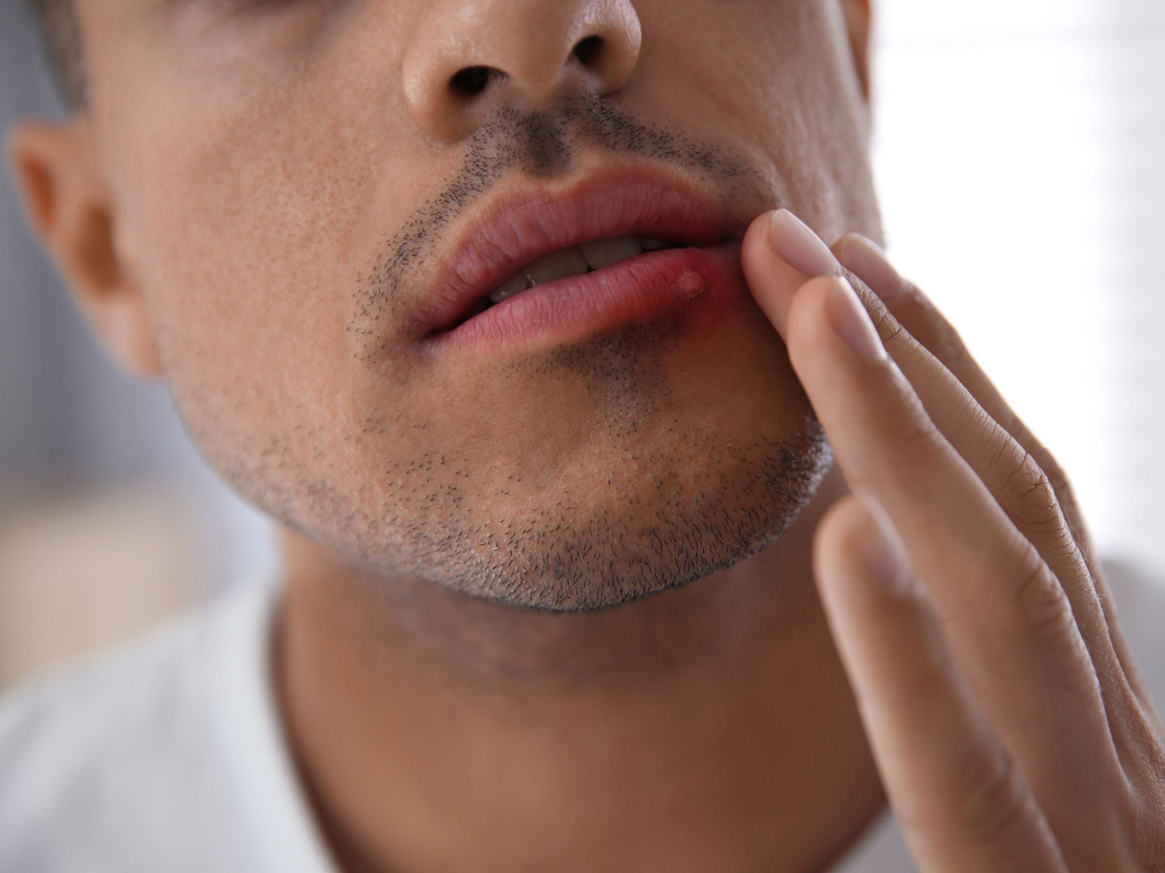 Man touching lip with cold sore or acne