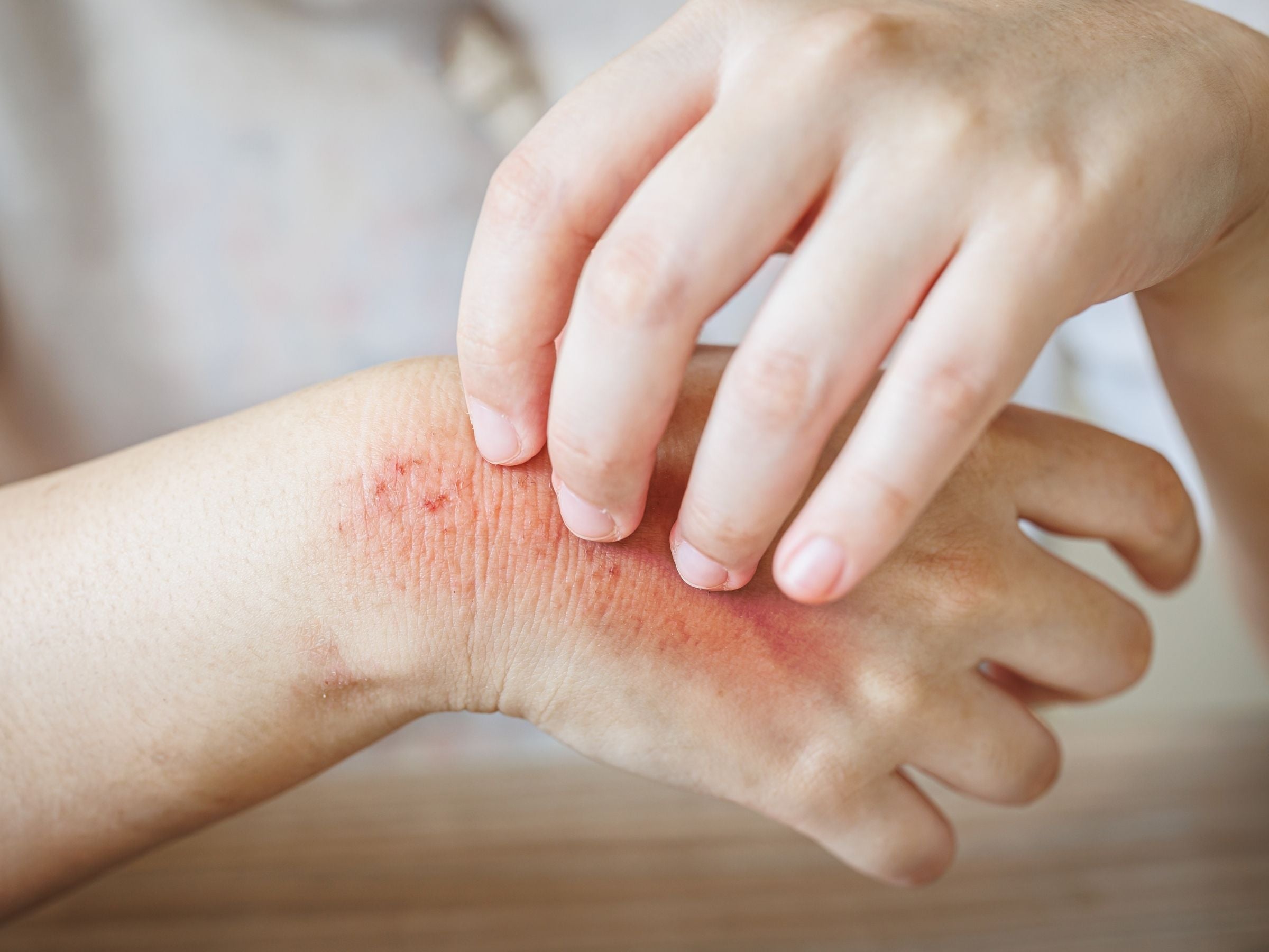 6 Tips to Reduce Eczema Symptoms and Live Better