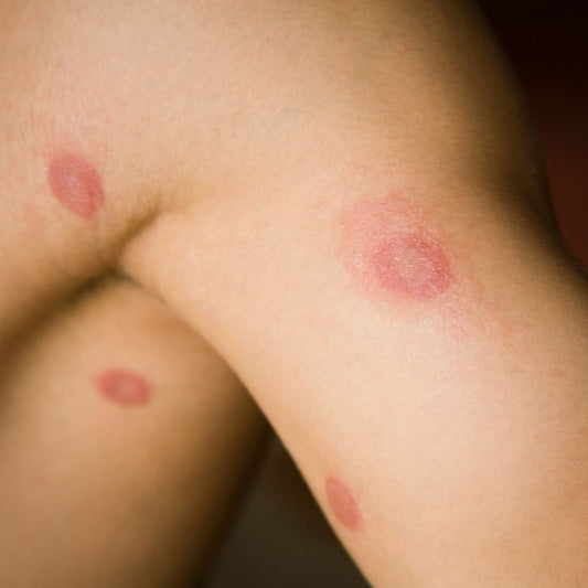 Does Your Child Have Ringworm?