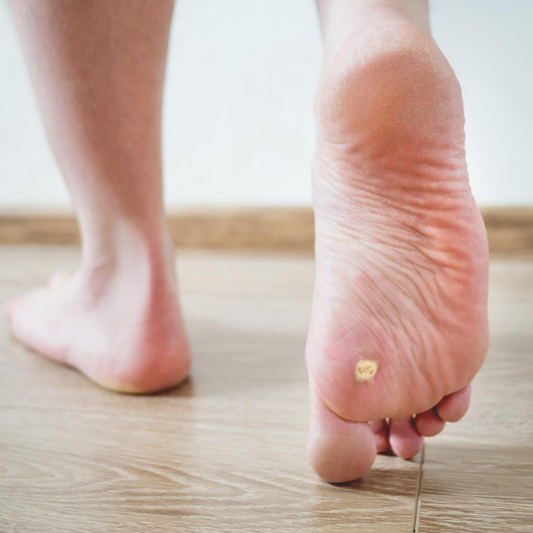 Plantar Warts, the most common