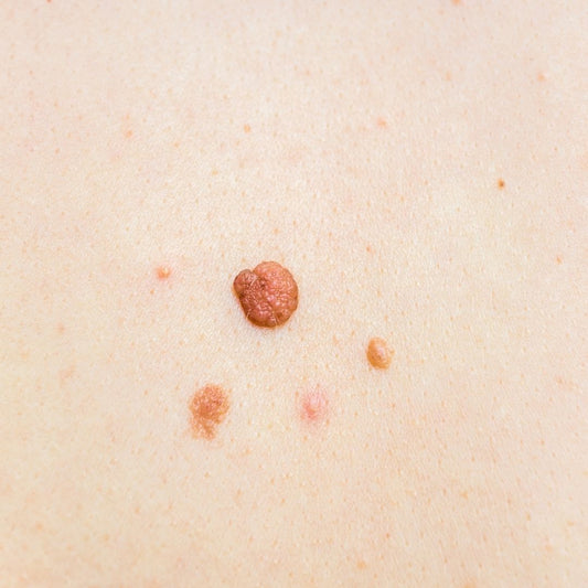 Is it a skin tag or something else?