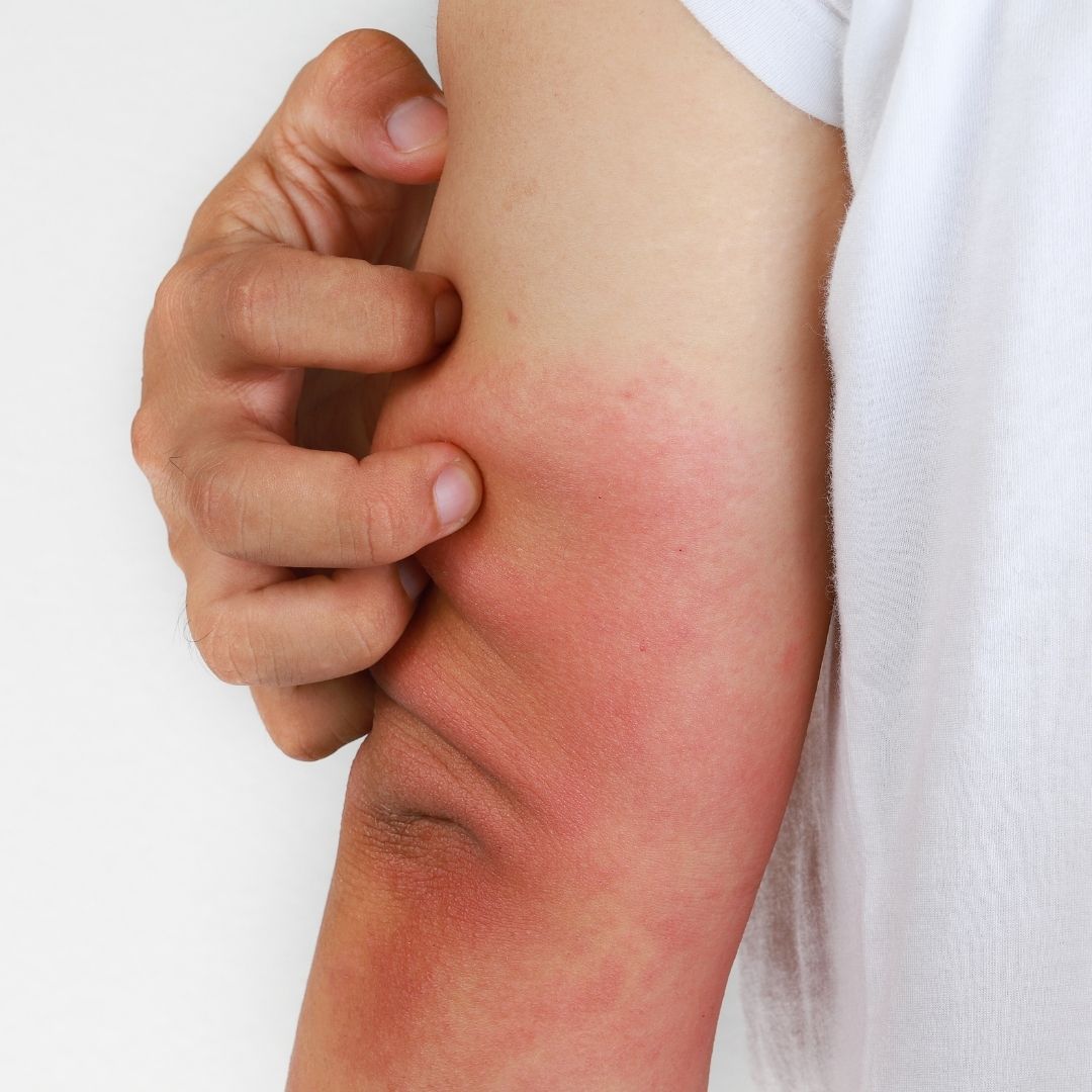 Itchy Eczema Elbow