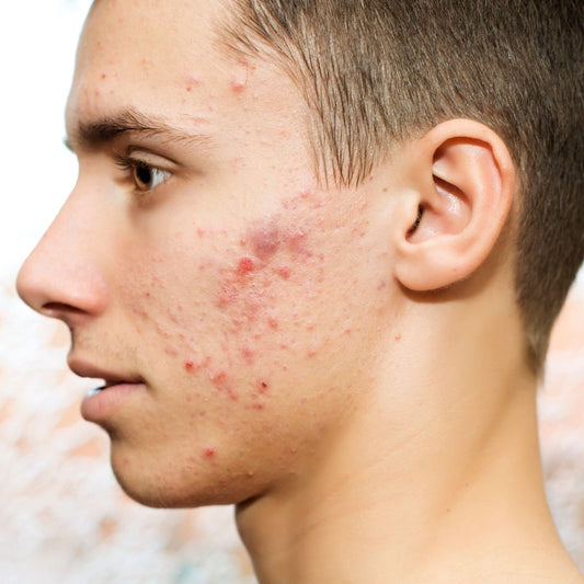 How To Treat Scars Caused By Cystic Acne