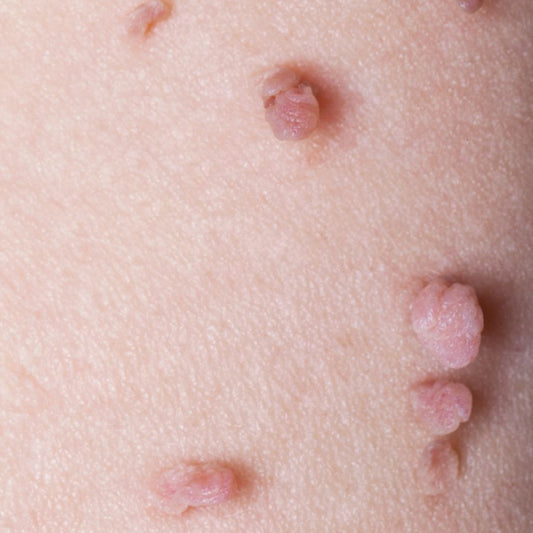 What causes Skin Tags?