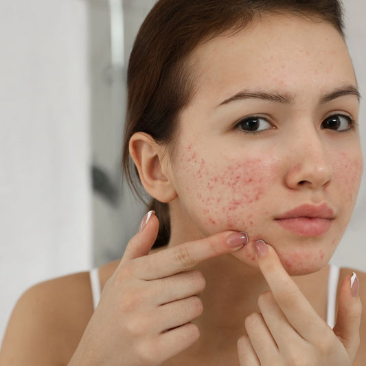 Teen girl with acne