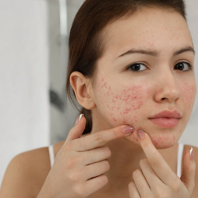 Teen Acne: 10 Tips on How to Manage & Prevent Breakouts