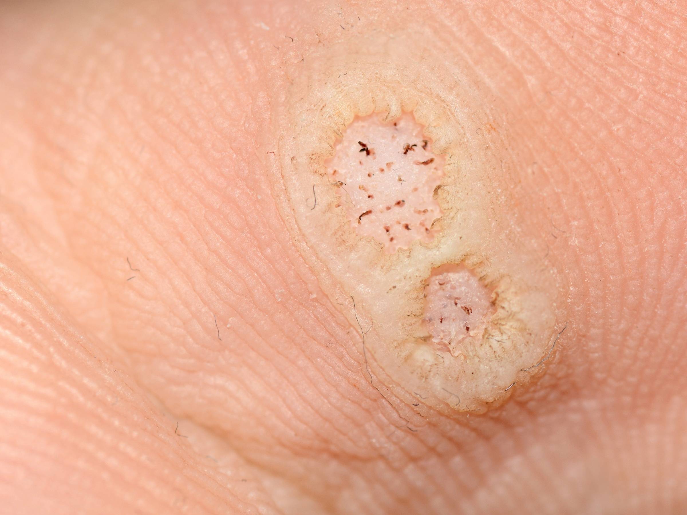 What Are Warts?